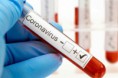 Coronavirus en Corrientes: Confirman un nuevo caso en Capital y suman 214 los positivos en la Provincia.